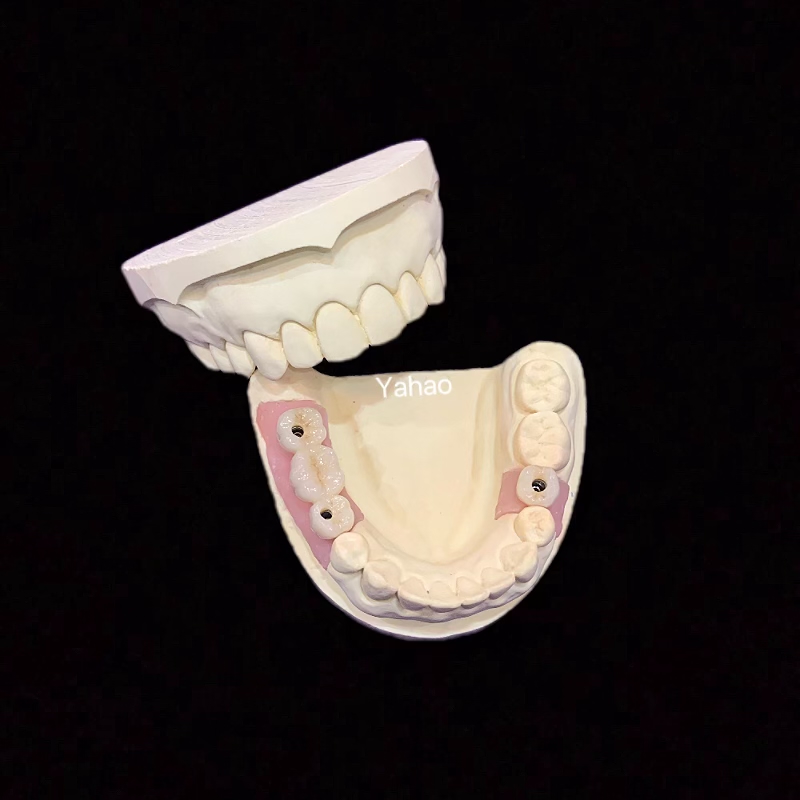 Implantation Of Cobalt-Chromium Porcelain Crowns And Bridges Implantation Of Zirconia Porcelain Crowns And Bridges