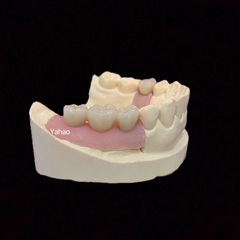 Implantation Of Cobalt-Chromium Porcelain Crowns And Bridges Implantation Of Zirconia Porcelain Crowns And Bridges