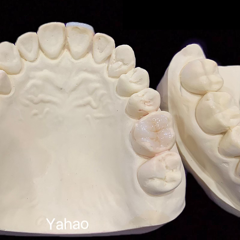 Ivoire Porcelain Veneers And Inlays