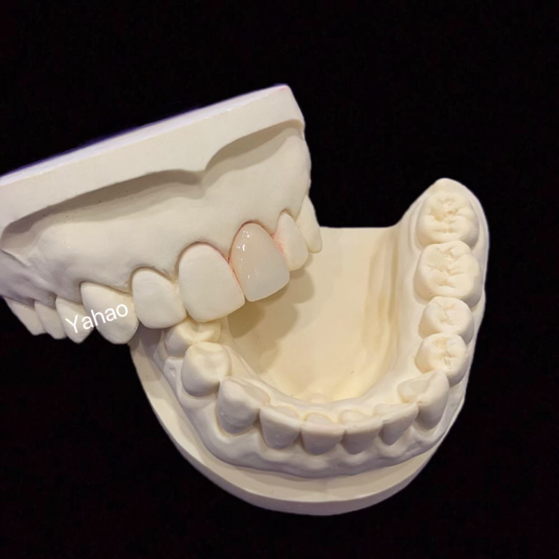 Ivoire Porcelain Veneers And Inlays